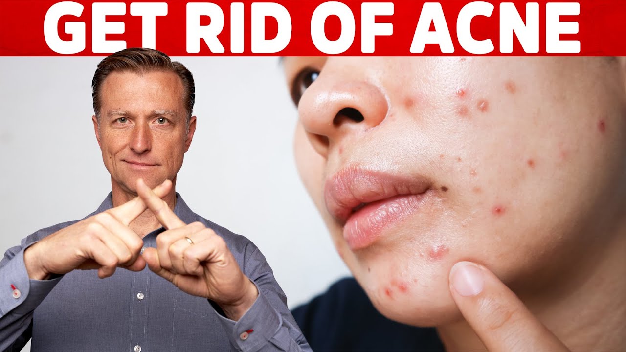 The Causes of Acne – How To Get Rid Fast – Dr.Berg