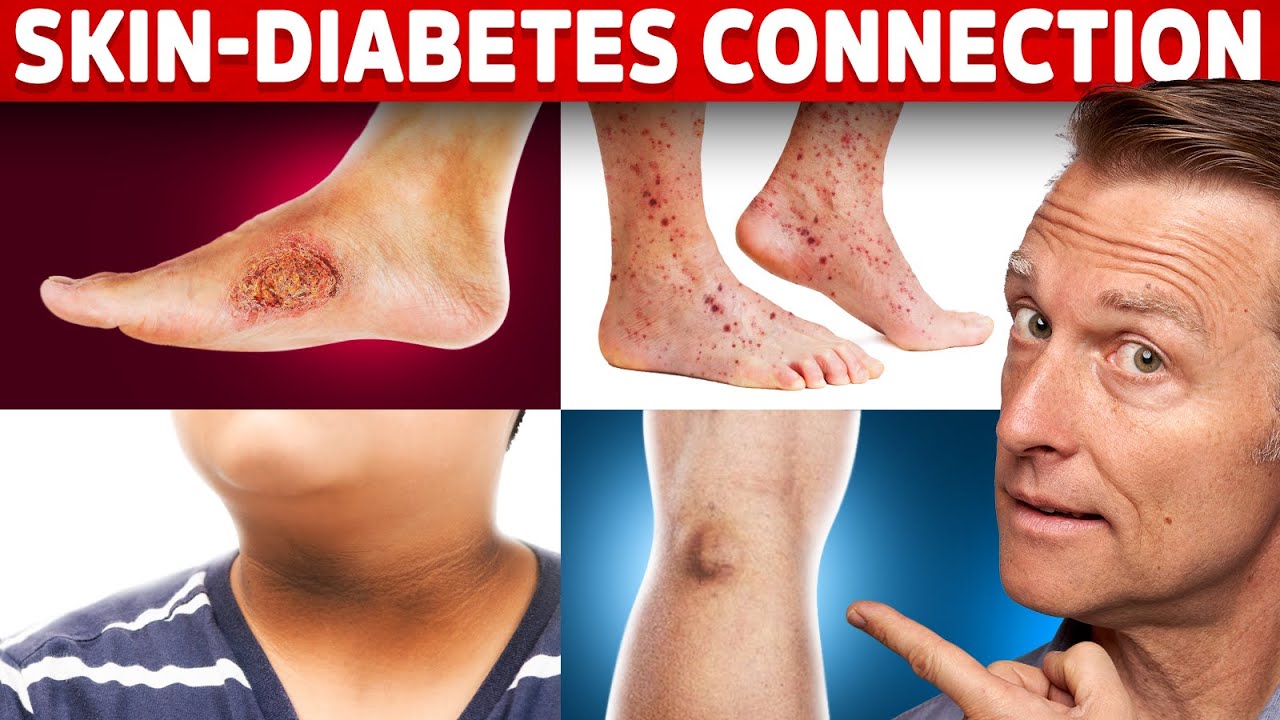 9 Diabetic Skin Problems That Indicate Diabetes Gadico Modern